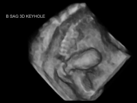 Luto 3D sagittal keyhole bladder